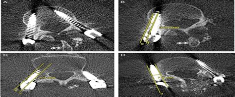 Safety And Accuracy Of Freehand Pedicle Screw Placement And Spine