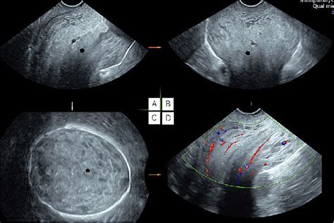 Cervical Edema And Cervical Length Of 8 8 Cm Color Doppler With 3d