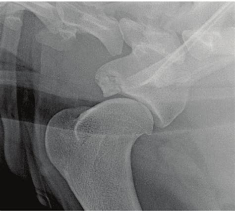 Mediolateral Radiographic Projection Of The Left Shoulder 16month After