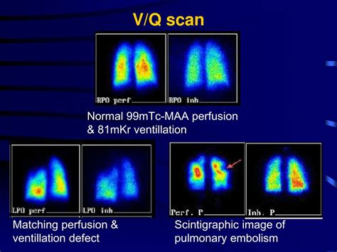 Ppt Ventilation Perfusion Vq Scintigraphy Powerpoint