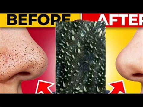 5 Unbelievable Blackhead Removal 2024 Hacks You Need to Try NOW! - b7cl6b8