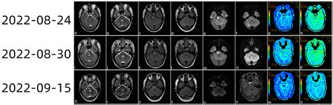 Frontiers Case Report A Case Of Abrupt Stroke As The First Symptom