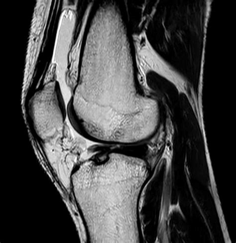 Smartspeed Traumatic Knee Imaging Philips Mr Body Map