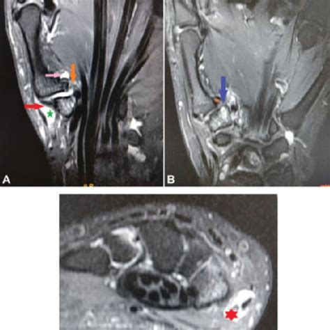 (PDF) First Carpometacarpal Joint Anatomy and Osteoarthritis: MR ...