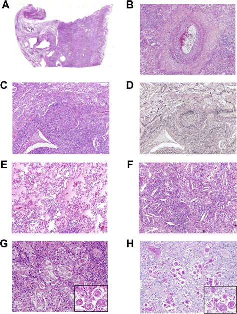 Surgically Resected Lung Specimens A Microscopic Examination With