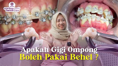 APAKAH OMPONG BISA PAKAI BEHEL BEHEL HARUS CABUT GIGI YouTube