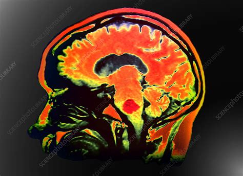 Brain Cancer Mri Stock Image M134 0404 Science Photo Library