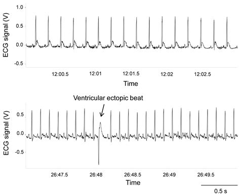 Resting Heart Rate Variability Predicts Vulnerability to