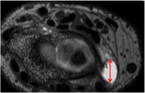 Prestyloid Recess Of The Wrist Normal Appearance On 3t Mr Arthrography