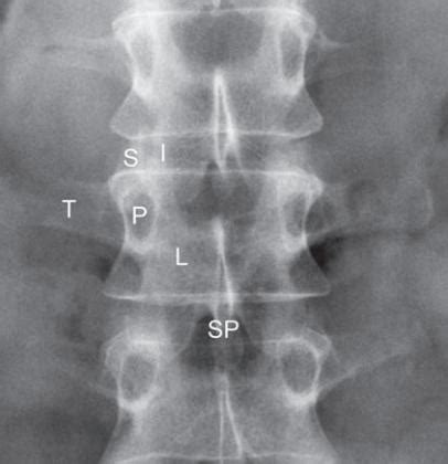 Lumbar Spine Anatomy - Spine - Orthobullets