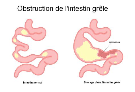 Qu Est Ce Qu Une Perforation Intestinale Hot Sex Picture