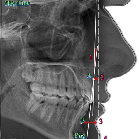 The Main Cephalometric Points And Measurements According To The Cogs Download Scientific