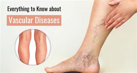 Everything To Know About Vascular Diseases