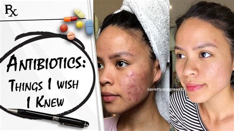 Acne Antibiotics Made My Acne Worse And How I Cleared My Skin After