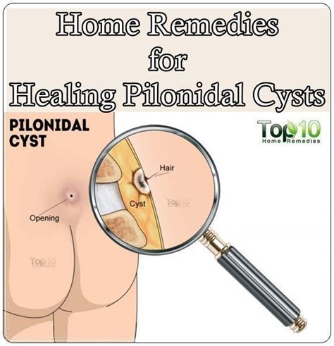 Tried And Tested Skin Care Tips Pilonidal Cyst Natural Health Remedies