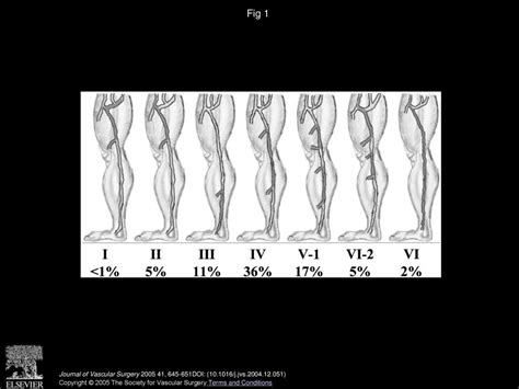 Patterns Of Saphenous Reflux In Women With Primary Varicose Veins Ppt