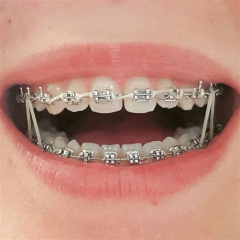 ปักพินโดย Shrood Burgos ใน Braces สีจัดฟัน จัดฟัน ฟัน