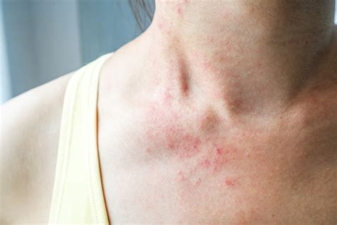 Keto Chow Blog - Is keto rash real? What causes keto rash?