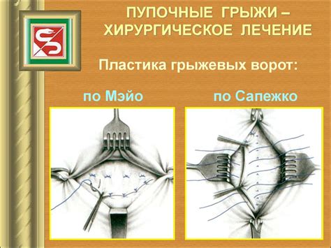 Грыжи передней брюшной стенки - презентация онлайн