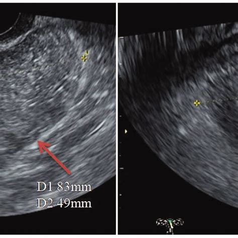 Three Dimensional Transvaginal Ultrasound Image Showed A Cystic Mass