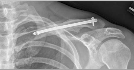 Clavicle Fracture Treatment | Clavicle Bone Fracture Surgery