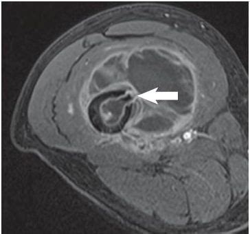 Infection | Radiology Key