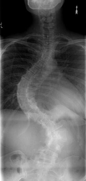 Short segment lumbar levoscoliosis with compensatory dextroscoliosis in ...