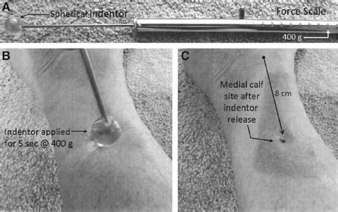 Standardized Pitting Edema Assessment Method Spherical Indentor Shown