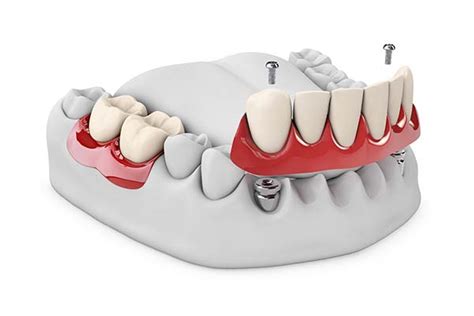 Por Qu Utilizar Pr Tesis Sobredentadura Sobre Implantes