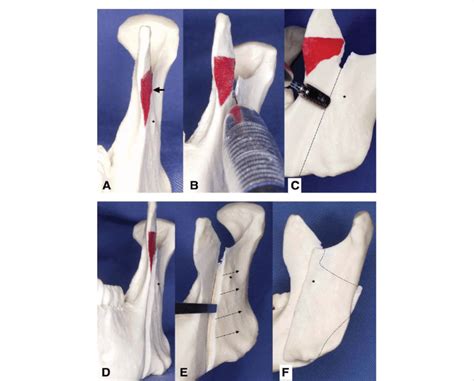 Surgical Procedure Of Intraoral Verticosagittal Ramus Osteotomy Using A Download Scientific