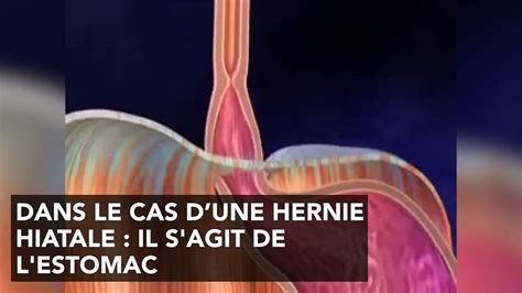 Hernie Hiatale Traitement Chirurgie Causes Sympt Mes Qu Est Ce