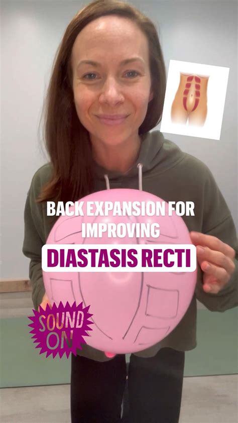 Diastasis Recti And Back Expansion Diastasis Diastasis Recti Fitness Tips