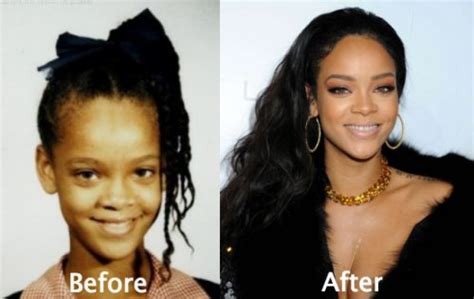 Rihanna Plastic Surgery Before And After Photos