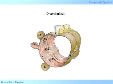 Gasztrointesztinális Betegségek Ii23 Diverticulosis