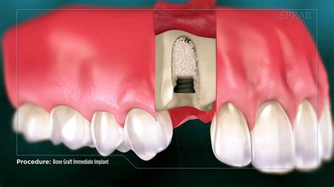 Bone Grafts Procedure in Karachi Low Cost | Rehan Dental Surgery