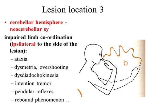 Cerebellar Dysfunction Syndromes Signs Examination Doc Mudr Valja