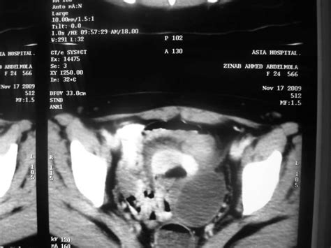 B Haemorrhagic Ovarian Cyst Tv Vaginal Ultrasonography Demonstrates A