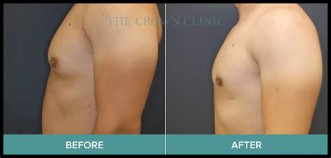 Gynecomastia Surgery In Melbourne Crown Clinic