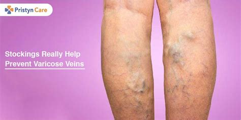 Do Compression Stockings Help Reduce Varicose Veins