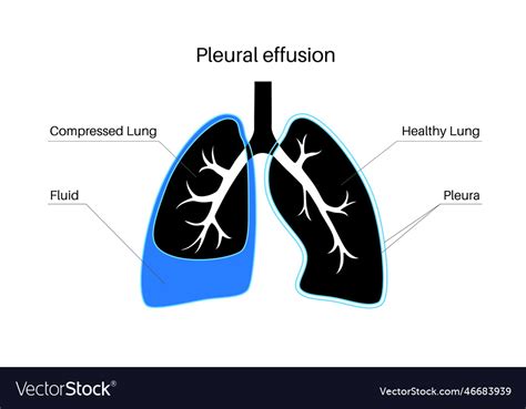 Pleural Effusion Poster Royalty Free Vector Image