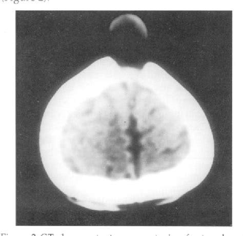 Figure 2 From Congenital Dermoid Cyst Of The Anterior Fontanel On