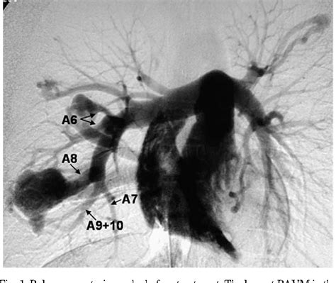 Figure From Segmental Arterial Ligation Under Video Assisted