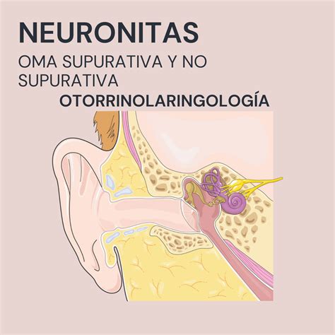 Otitis Media Aguda Supurativa Y No Supurativa Neuronitas Podcast