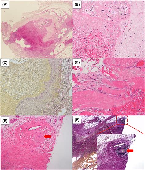 (A‐C) Histopathologically, there was necrotizing vasculitis in ...