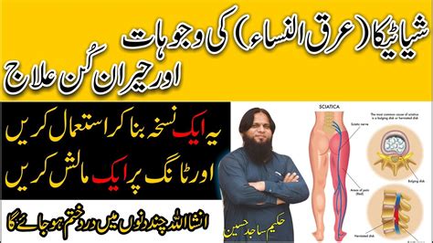 Treatment For Sciatica Pain Arqunisa Ka Ilaj Back Pain Treatment