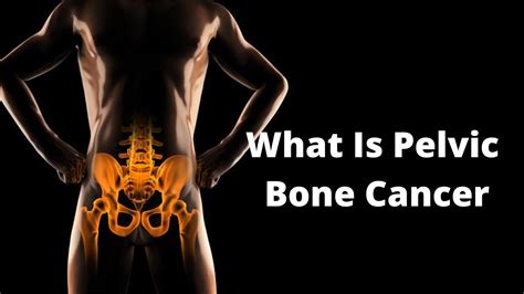 What Is Pelvic Bone Cancer Youtube