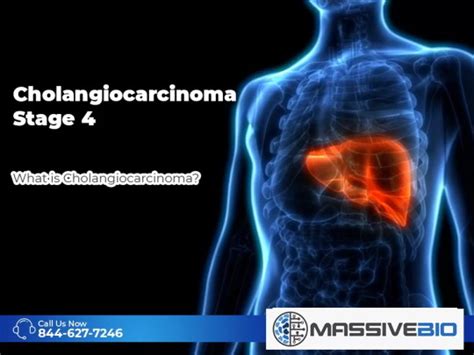 Cholangiocarcinoma Stage 4 - Metastatic Cholangiocarcinoma