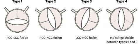 Morphological Criteria For Bav Phenotype Classification Bav Bicuspid