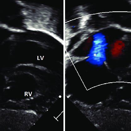 Transthoracic echocardiogram image from the subcostal plane showing... | Download Scientific Diagram