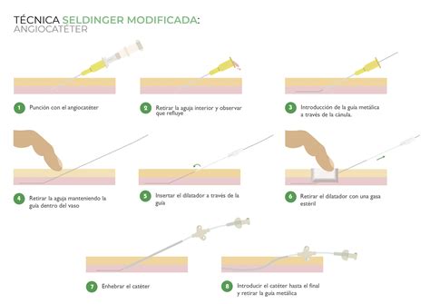 Canalizaci N Picc Neonatal T Cnica Seldinger Modificada Angiocat Ter